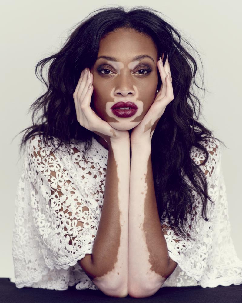 Η Chantelle Winnie, με τη δερματική δυσχρωμία, έγινε το πρόσωπο της Diesel.